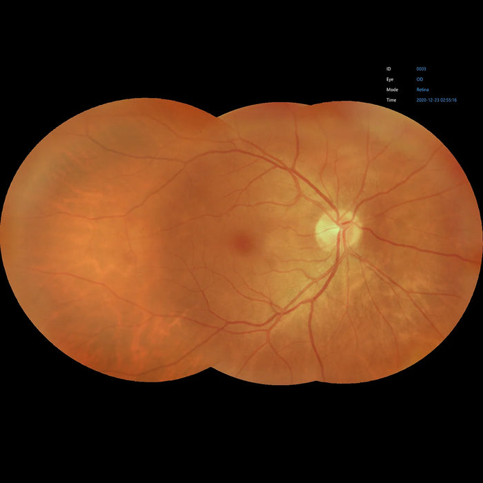 Automatic Non-Mydriatic Retinal Camera EFC-2600 – 12 MP